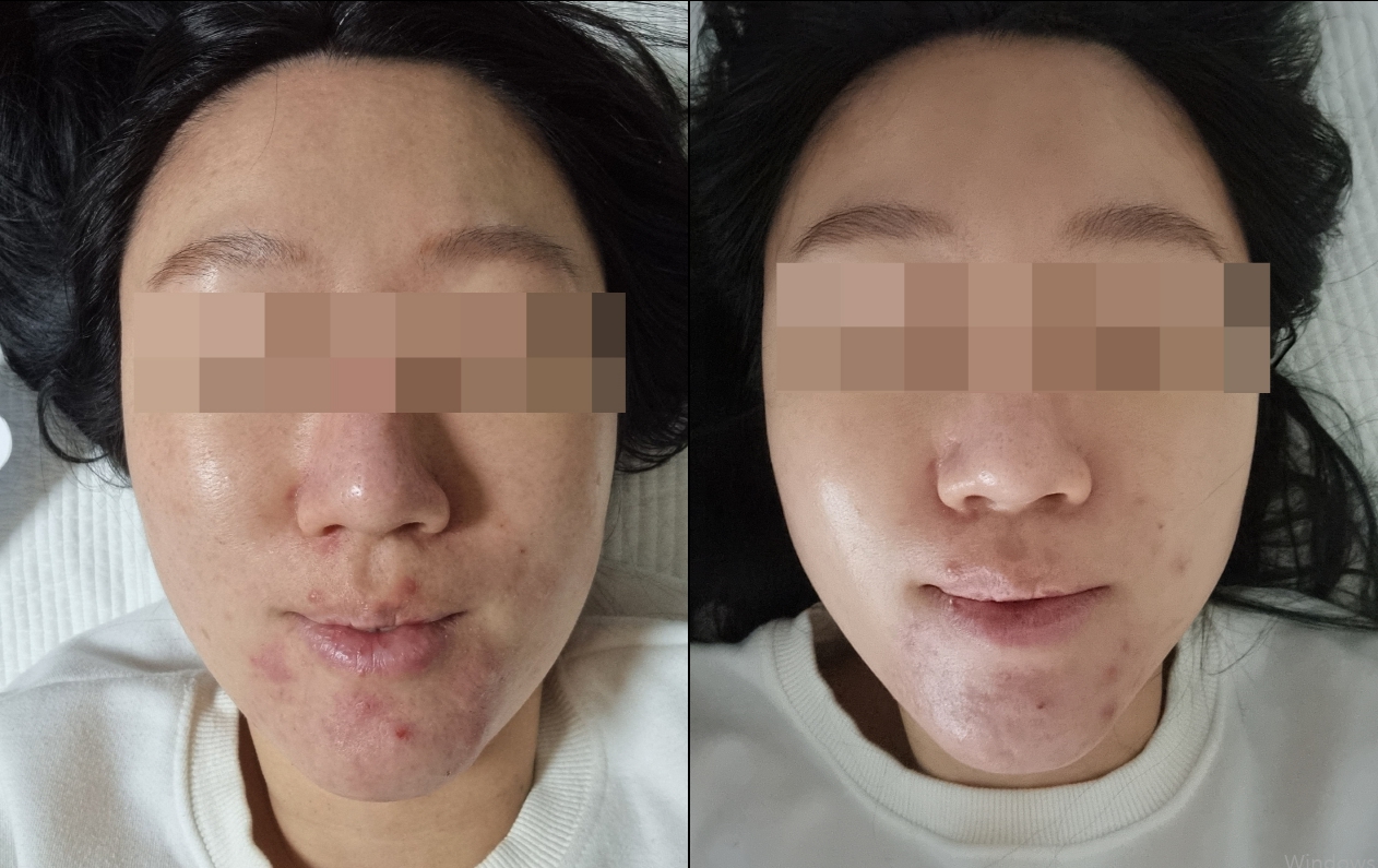한결부스터 실제 사용례 첫 번째 전후 비교